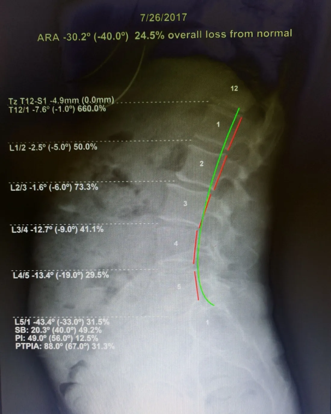 After Chiropractic BioPhysics treatment posture