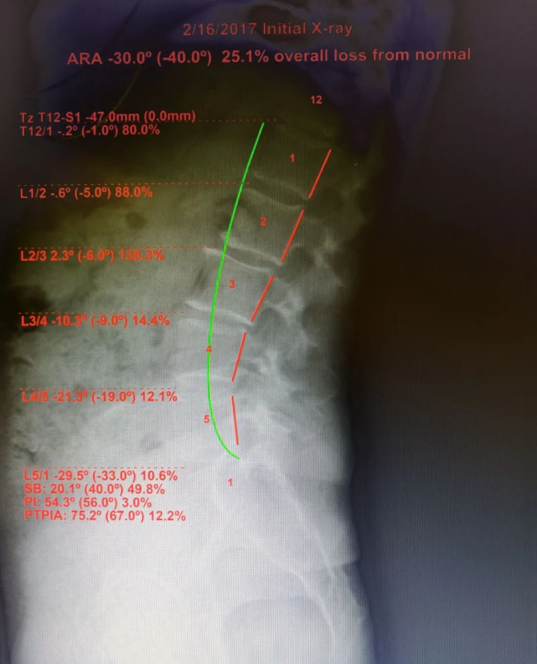 Before Chiropractic BioPhysics treatment posture